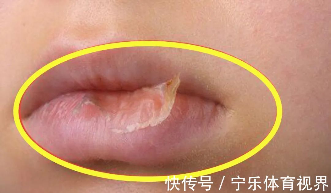不良习惯|孩子嘴唇干裂、起皮还出血怎么办?医生教你正确护理,比喝水管用