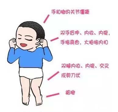 危险因素|天使科普:哪些因素会导致婴儿出现脑瘫?