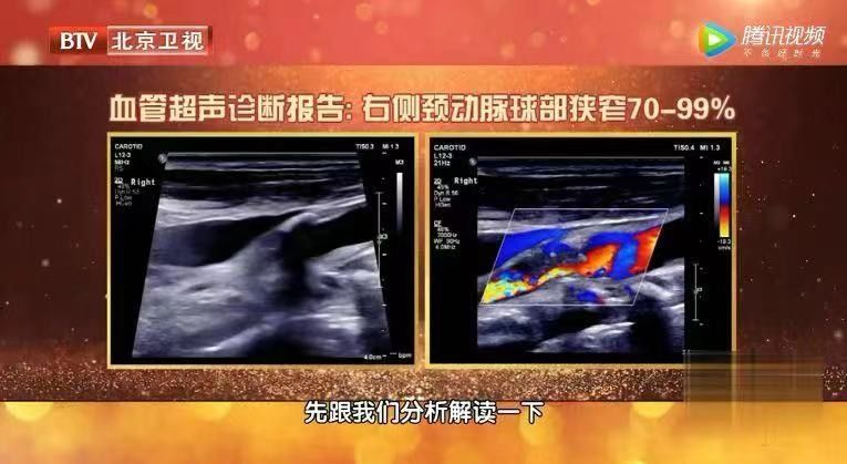 血流|2年没复查，息肉变成癌！B超报告里出现“这些字眼”可能就危险了，别等严重时才后悔