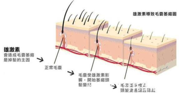 双氢睾酮|脱发自救指南,快快学起来