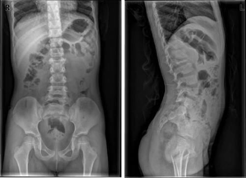 椎体|脊柱常见肿瘤及肿瘤样病变的几种影像学表现,你都见过吗?
