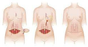 保乳|重医二院·聚焦前沿｜第41期 乳腺癌还在“一切了之”？保乳与保命不再两难