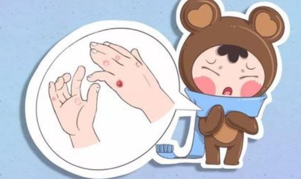 中医|“冻疮”是冬天极为常见的皮肤病,怎么去治疗冻疮呢中医有妙招