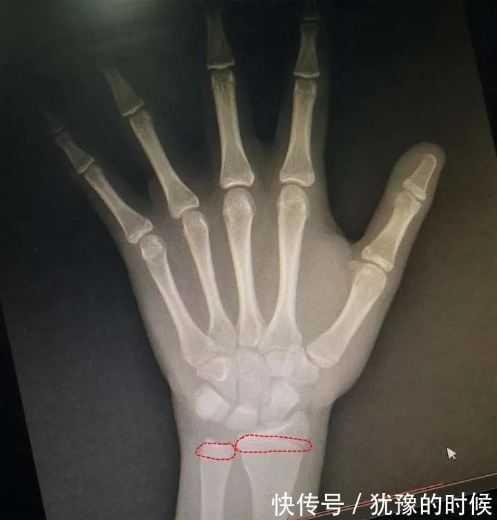 骨龄|1米6就不长了!妈妈悔惨:儿子才13岁,6岁弟弟的情况更糟