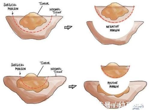 手術|手術后癌癥病人怎么知道腫瘤是不是切干凈了？