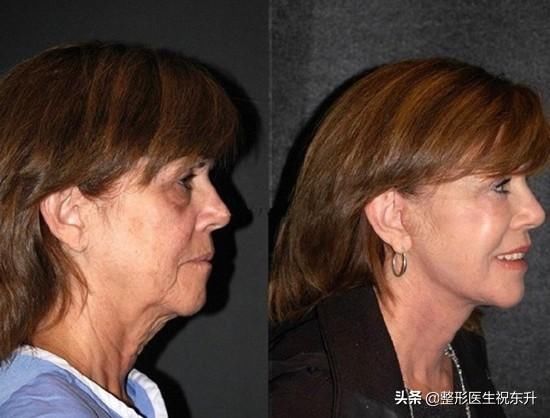 怎么提升侧颜的高级感？医生来支招：找回消失的下颌线