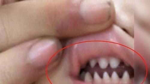 医生|2岁宝宝长出一口“鲨鱼牙”,宝妈痛哭求助,医生无奈:自作自受