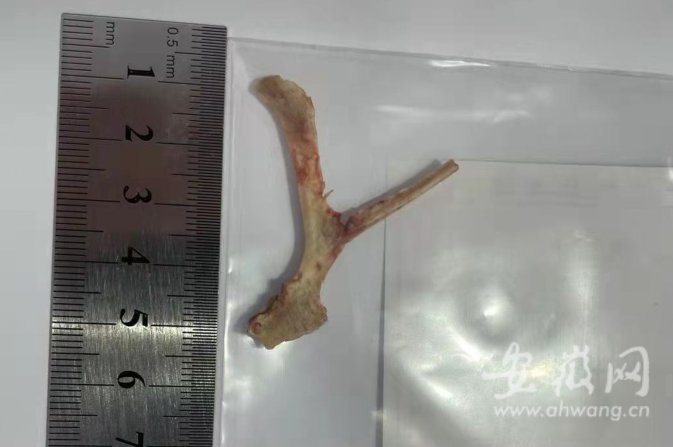 女孩|合肥一15岁女孩咳嗽不止 “元凶”竟是一块“Y”型巨大鸡骨头