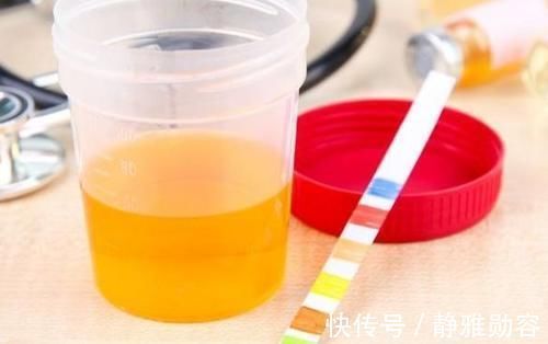 蛋白尿|蛋白尿高的患者留意了!不想加速肾衰竭,此3个饮食禁忌别再犯了