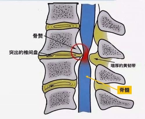 颈部|走路像脚踩棉花，是脑梗还是颈椎病？