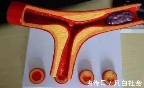 血管堵塞|体内出现血栓时,身体会有这4个表现,及时察觉或许能救你一命!