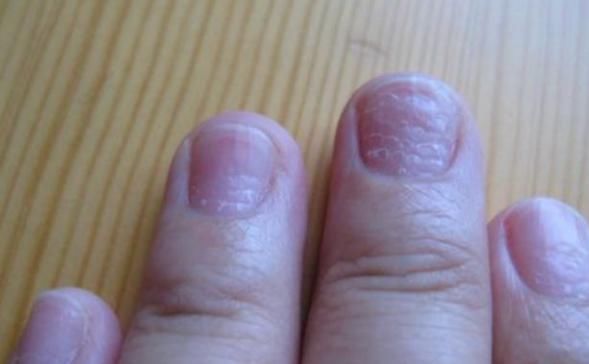 慢性炎症性皮肤病|身体生病,指甲先知?指甲若有5种表现,或许是疾病的“信号”!