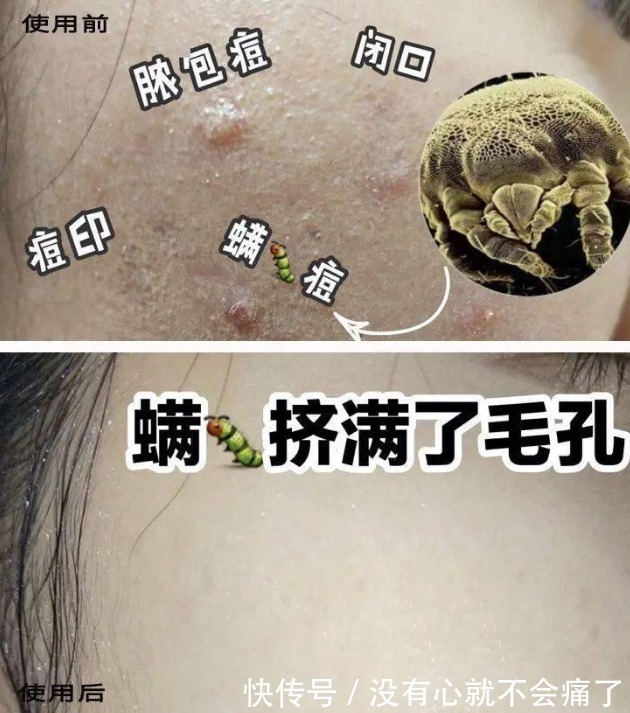 皮肤|脸上长痘痘的原因?怎么去痘痘的方法最快最简单(美容师分享)