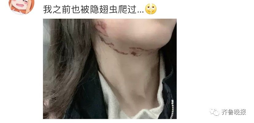 毁容|女子被虫子爬过脸颊险毁容，网友：再也不敢关灯玩手机了