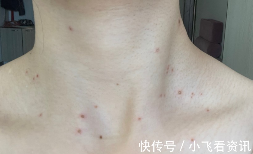 身体|身体3个地方发痒，是HPV来了，趁早去检查，别误以为是过敏