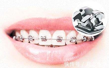 矫治|儿童做牙齿矫正三个最佳时间:家长要牢记,矫治越早干预效果越好