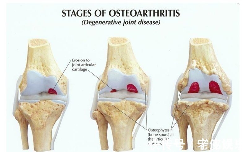 郝伟|微创膝关节单髁置换术，让骨性关节炎患者保留“膝”望