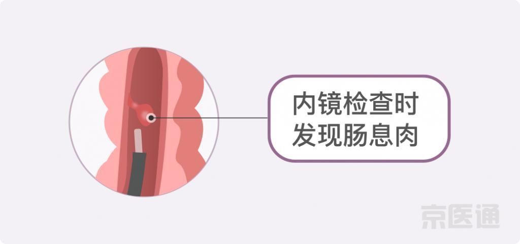 癌症|结节、息肉、囊肿是癌症先兆吗？北肿专家们说出了真相！