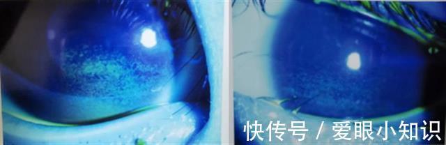 爱尔眼科医院|糊涂妈经常给女儿拔倒睫,结果杯具了!