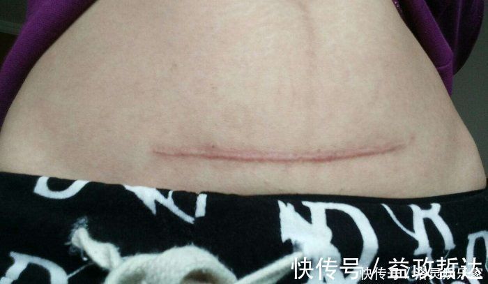 预产期|剖腹产没半年又怀孕,孕30周后子宫破裂,大人保住了孩子却没了