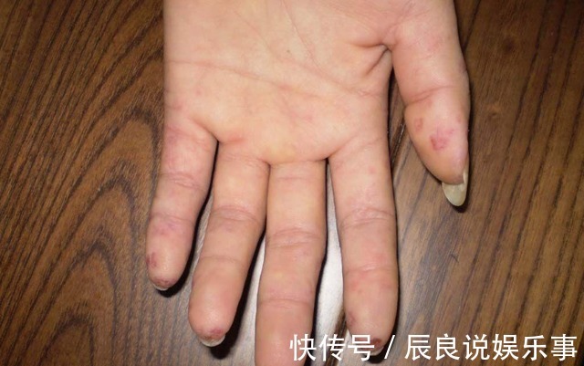 医生|夫妻俩先后查出肺癌,医生:手部早就给出提醒,却没及时发觉