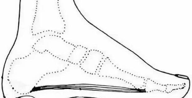 跟骨|足跟痛的5大原因,减轻跟腱对跟骨的拉力,而减轻病痛,建议了解