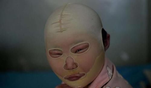 水泡|男孩被开水烫伤,宝妈的做法被全家人反对,送医后反被医生夸赞