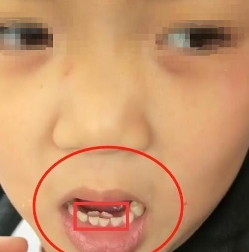 乳牙|8岁男童长出“双排牙”,被拔掉时疼哭了,得知原因后奶奶崩溃