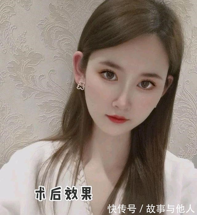 医美小白 光子嫩肤为什么受人追捧!