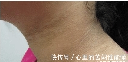 发黑|9岁小女孩脖颈发黑洗不掉,经医院检查后,医生的话却让家长笑了