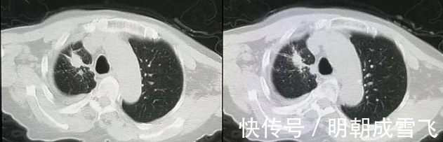 病人|癌症晚期病人差异这么大？有人可以5年以上，有人只有9天寿命？