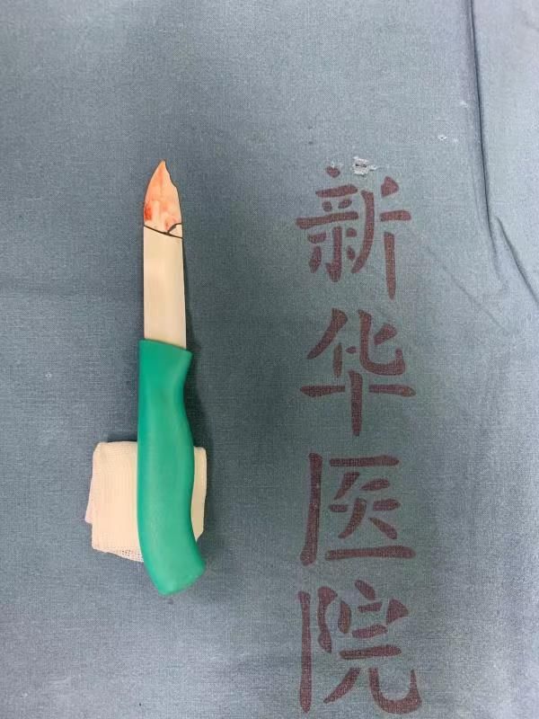 刀片|陶瓷刀刺入一岁女婴颅内留下4厘米断刃，上海医生手术取出