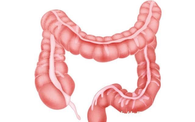 患者|早期不痛不痒的大肠癌，若发现这“5个异常”，或该去医院检查了