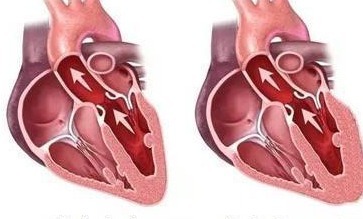 食物|加速高血压的3种食物,若你一个都不爱吃,那恭喜了