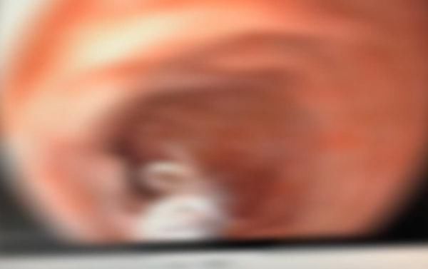 男子腹痛难忍,肠道中夹出8条活虫