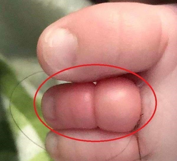 脚趾|11月龄宝宝脚趾进“虫”，家长紧急送医，医生直言幸好来得早