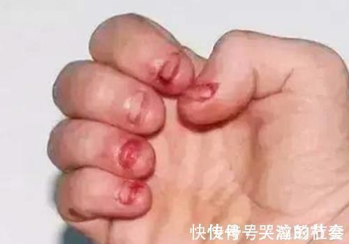 坏习惯|孩子咬指甲的毛病可能不是缺营养,两种心理诱因,家长需自查