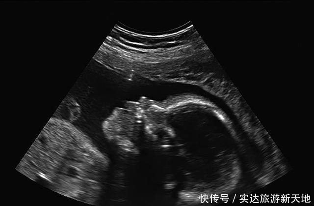 染色体|孕期B超单直接反应胎儿状况,这5处孕妈要学会看懂,医生不会详说