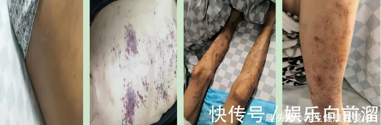 乙型肝炎|34岁确诊晚期肝硬化,从绝望到重生,我靠这一疗法战胜了它