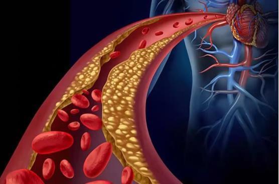 血管|高血脂“克星”公开，避免做这几件事，血管干净通畅