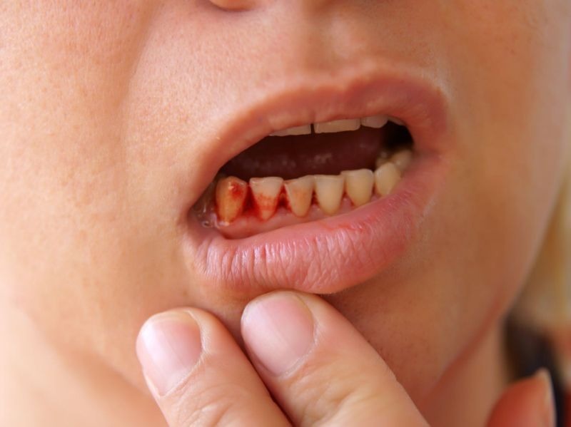 肿瘤|一歌手因牙龈癌去世,牙龈癌是什么病,它有什么症状