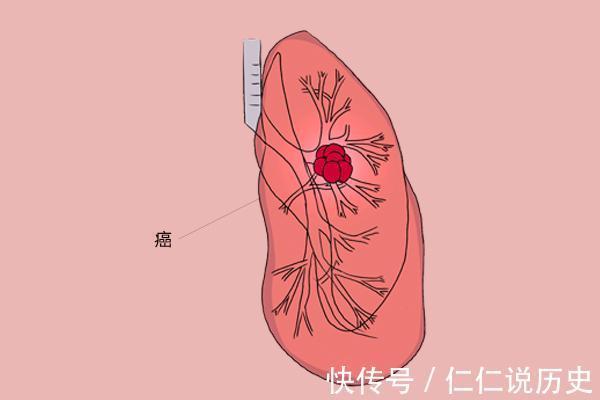 劉醫生|一位胸外科醫生父親肺癌轉移，他想放棄治療，我堅決不同意