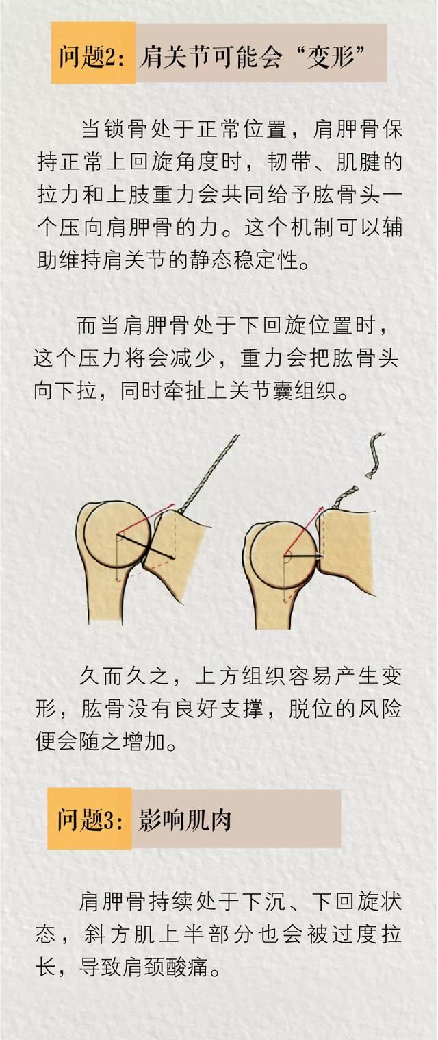 人类|直角肩到底有多“反人类”?骨科医生说出了大实话……