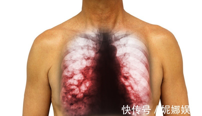 乳腺结节|结节,息肉,囊肿和增生,可能转变成癌症的前兆,哪个更容易恶变