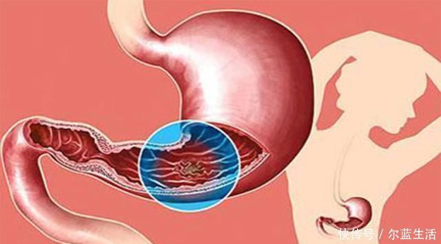 早期胃癌|“胃癌从早期到晚期”大概需要经历多长时间