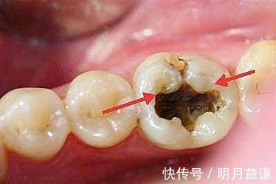 口腔疾病|哪些疾病需要在备孕的时候处理，否则怀孕后可能会后悔莫及？