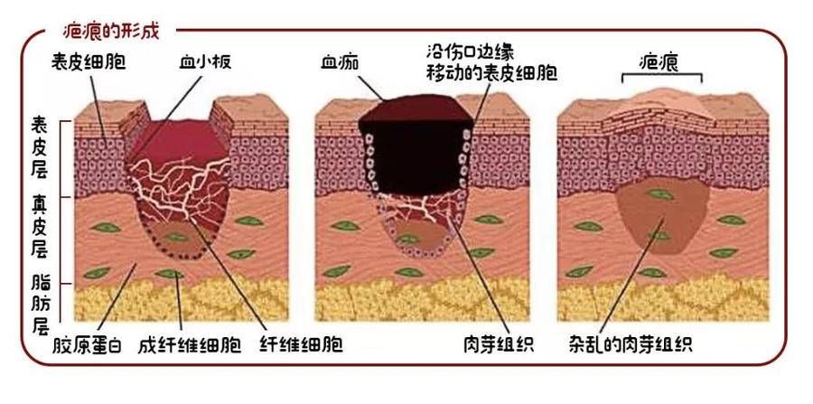 伤口愈合|同样是受伤，同样很好愈合，为什么别人只留下了印，我却留了疤？