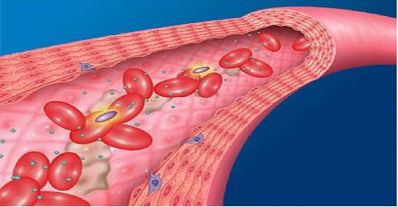动脉粥样硬化|老年人每天一颗鸡蛋,对动脉粥样硬化的发生影响有多大