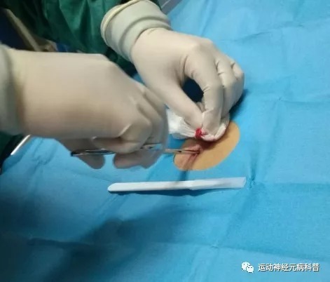 运动神经元病|运动神经元的肠内营养管理