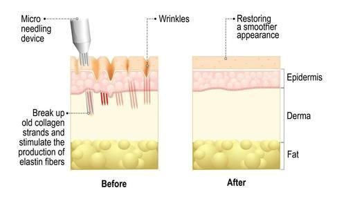 小可爱们|胶原蛋白VS玻尿酸,拿什么拯救这张不想衰老的脸